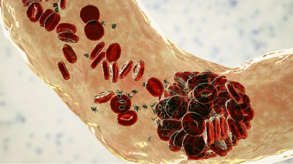 عامل مفاجئ يزيد من خطر الإصابة بتجلط الدم