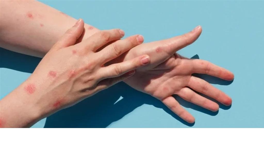 الصحة العالمية: جدري القردة ليس كورونا جديداً