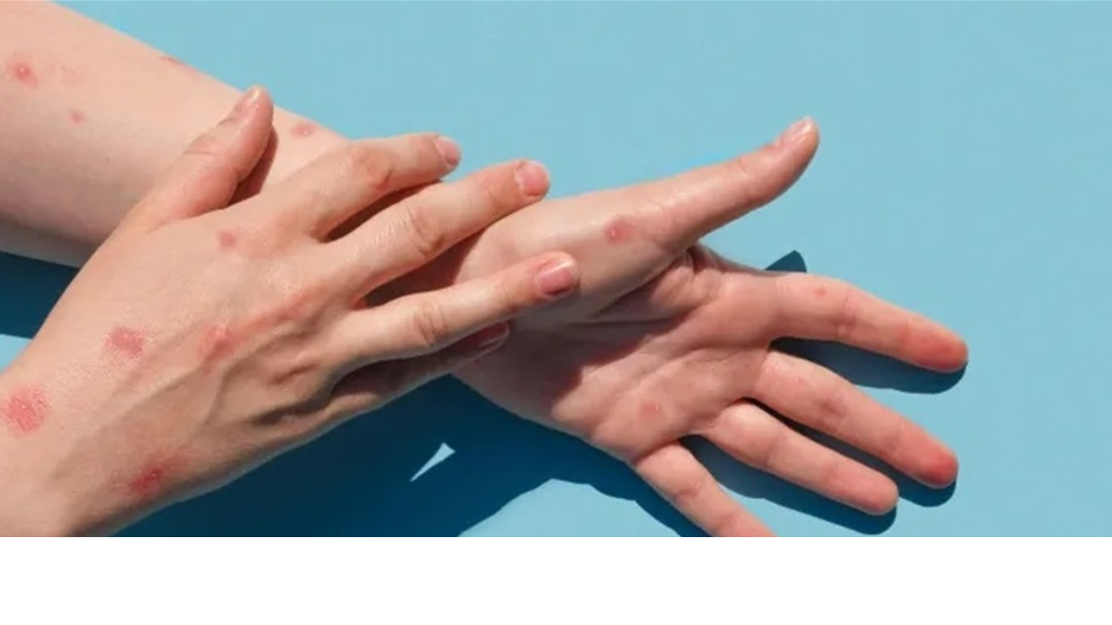 ما حقيقة انتشار جدري القردة في تركيا؟