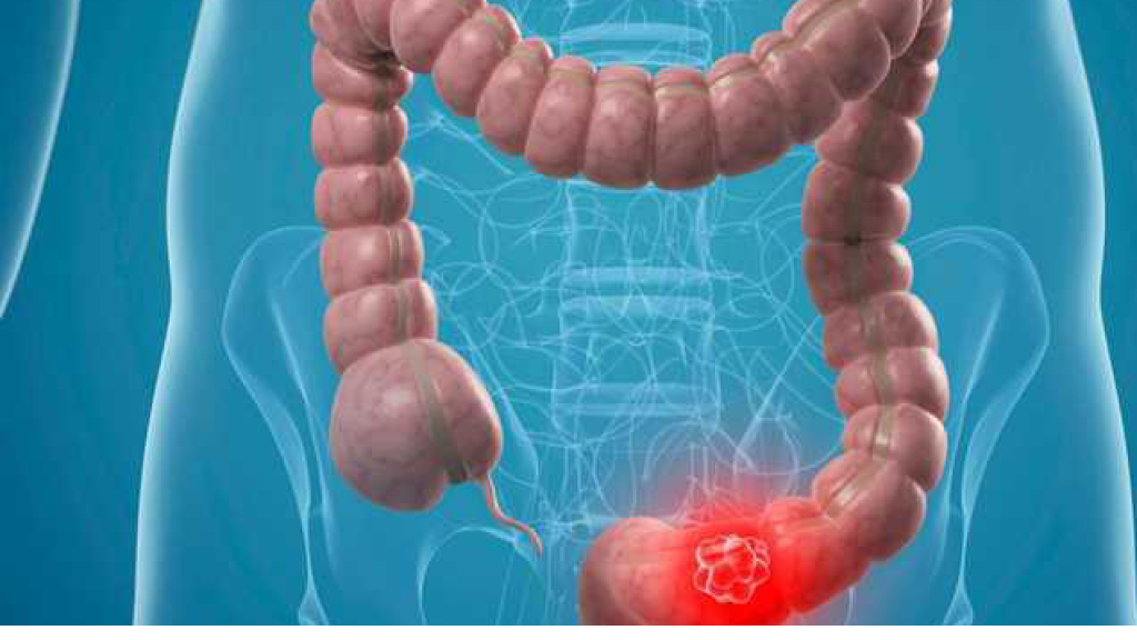 طبيب بريطاني يربط بين المكملات الغذائية وسرطان القولون