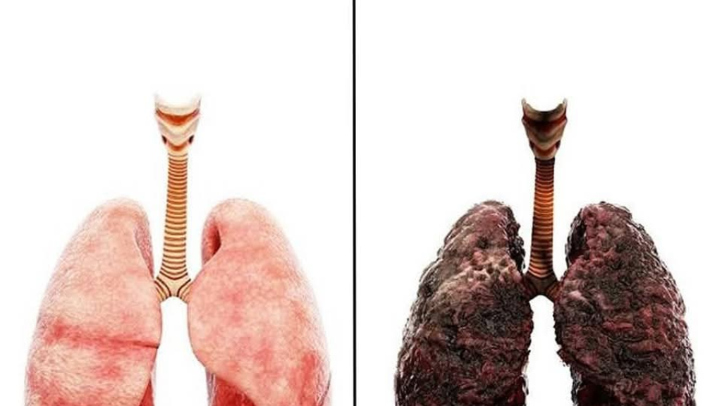 أكثر أسباب الوفاة في العالم ... بسبب التدخين
