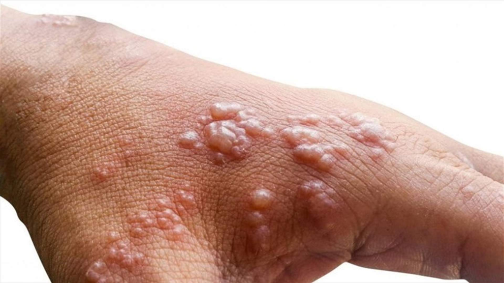 منظمة الصحة العالمية: جدري القردة لا يزال يمثل حالة طوارئ صحية عامة