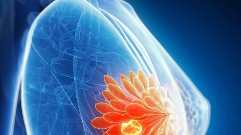 استراتيجية علاجية جديدة لسرطان الثدي العدواني، محققةً معدل نجاة مذهلًا بنسبة 100%!