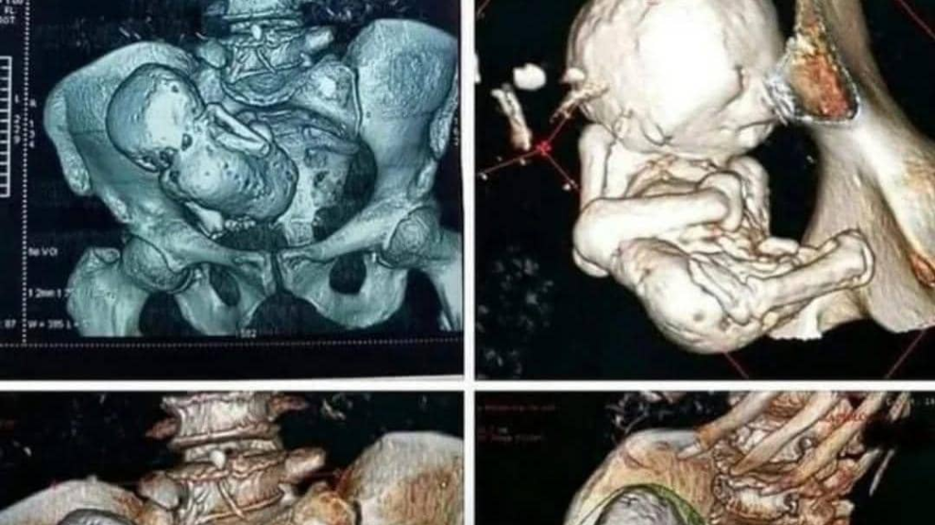 اكتشف العلماء أن امرأة تبلغ من العمر 73 عامًا كانت تحمل جنينًا متكلسًا داخل بطنها... لمدة 35 عامًا