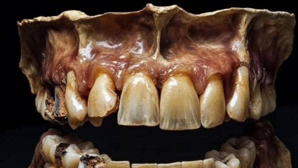 تسوس الأسنان يُسبب مشاكل قلبية خطيرة