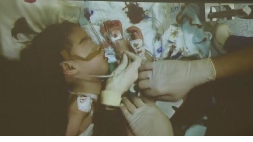 نجاح عملية فصل التوأم السوري سيلين وإيلين في الرياض (فيديو)