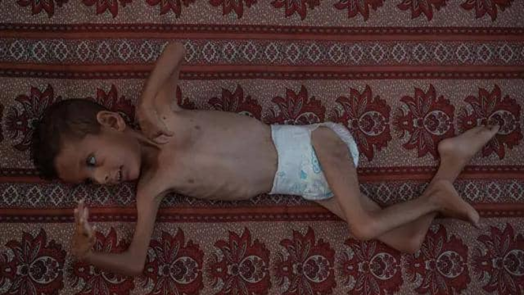 كيف يؤثر نقص الغذاء على مستقبل أطفال غزة