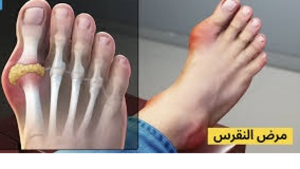 إعادة إحياء جين بشري مفقود منذ ملايين السنين لمحاربة مرض النقرس