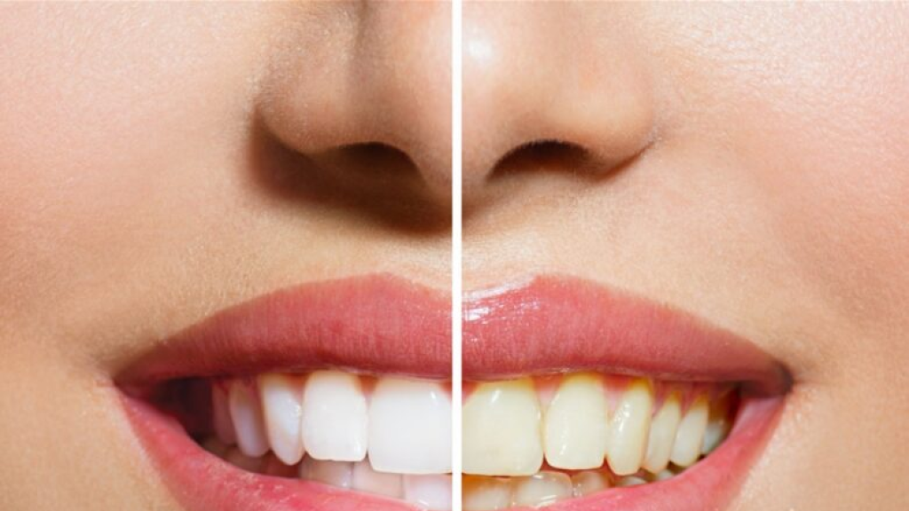 أطعمة تجعل أسنانك تصفر..!!!