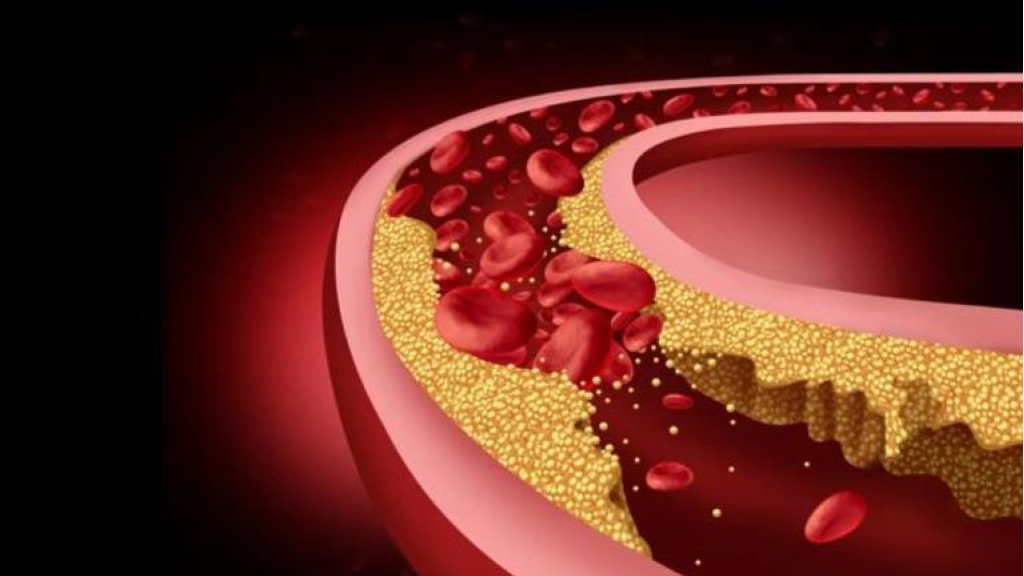 علاج جيني جديد يخفض الكوليسترول 