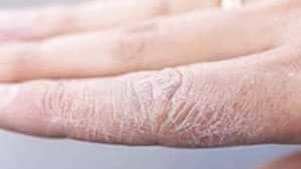 مع اقتراب فصل الشتاء.. 3 خطوات ضرورية لحماية البشرة من الجفاف