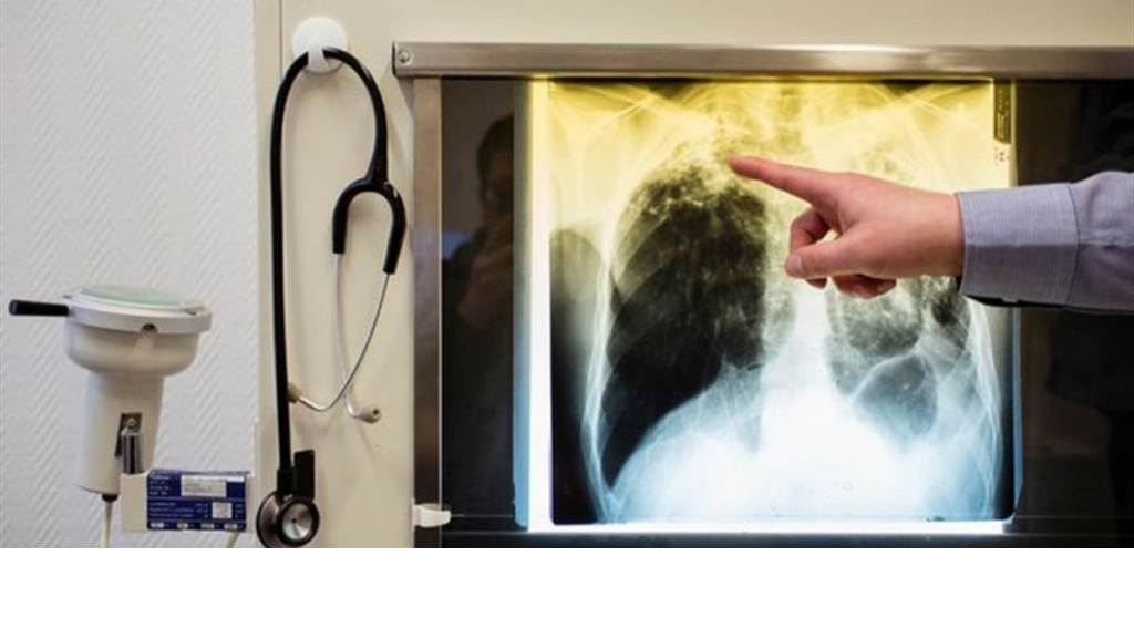 رغم انخفاض نسبة وفياته... هذا المرض ما زال الأكثر فتكًا في العالم