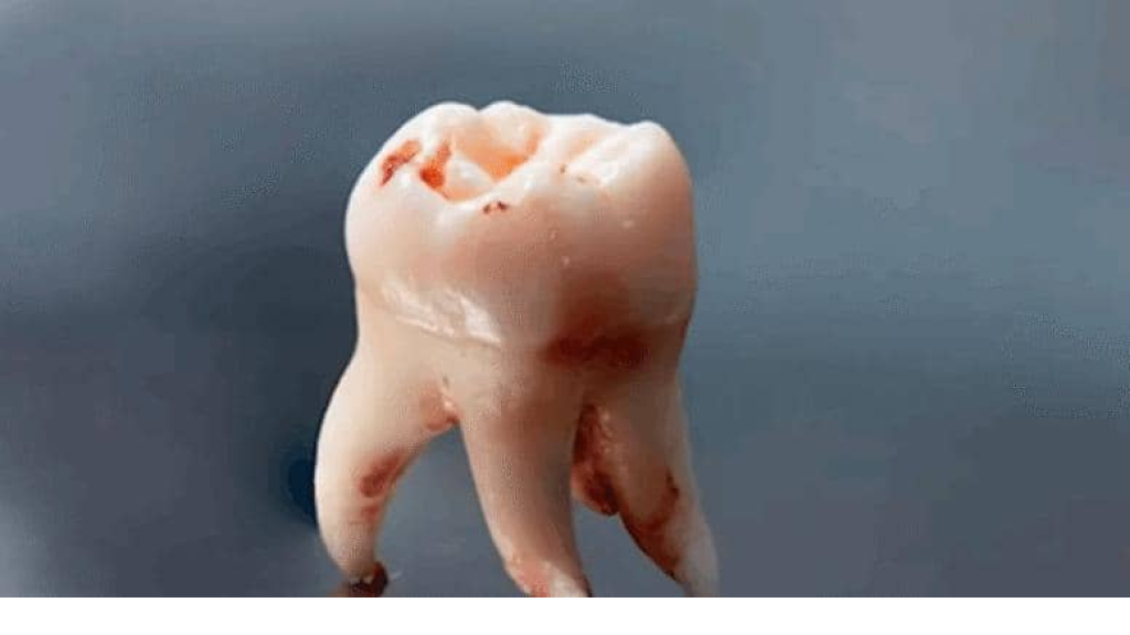 بعد خلع ضرس العقل.. 4 مشروبات يجب الابتعاد عنها