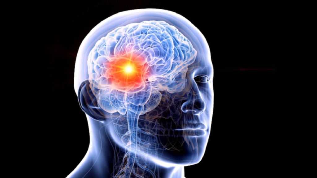 طريقة مطورة لعلاج أحد أخطر أورام الدماغ