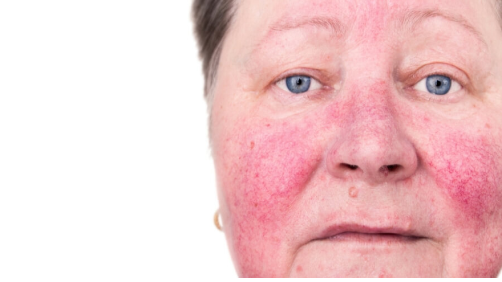 لماذا يزداد احمرار الوجه مع التقدم في العمر؟  