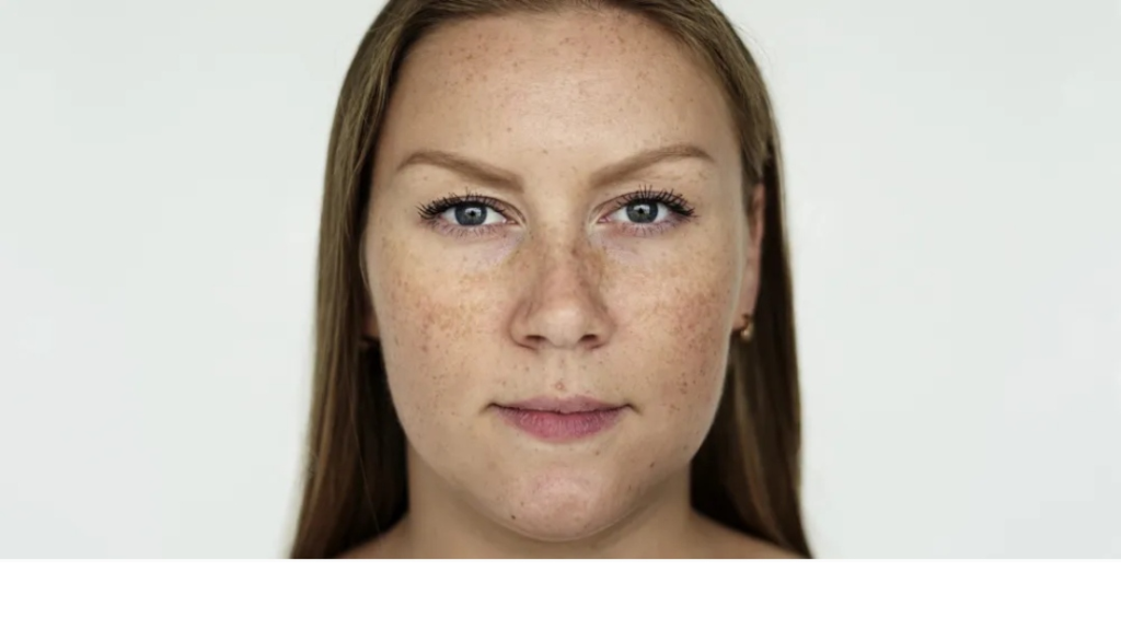 هل تعانين من الكلف؟ 5 حقائق قد تغيّر طريقة تعاملك معه تمامًا