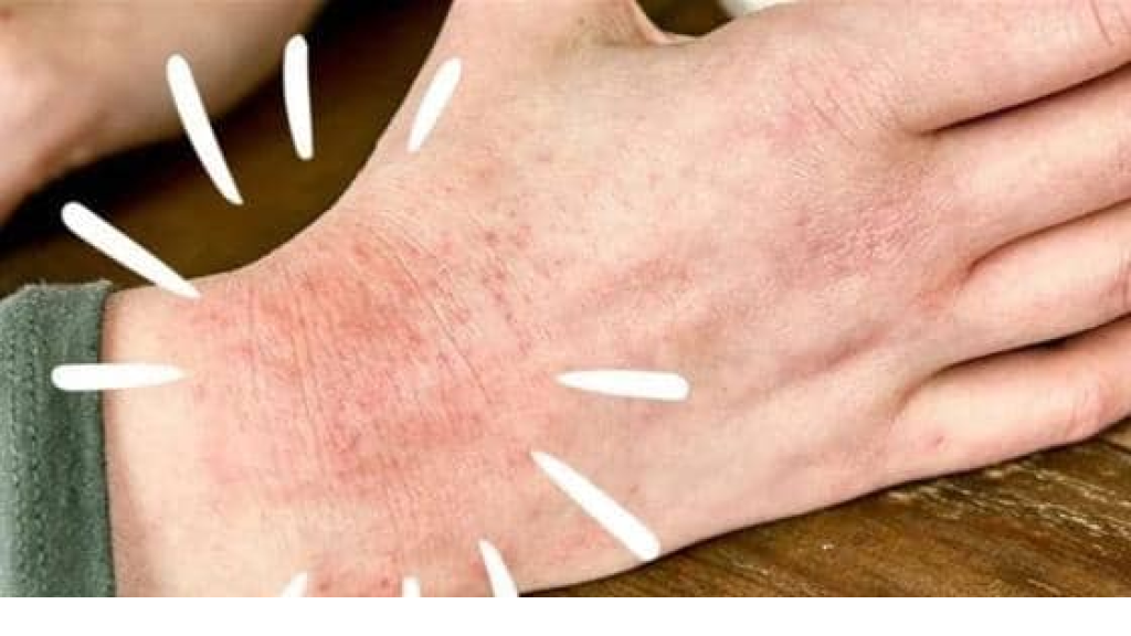 نصائح للتخلص من مشكلة إكزيما الشتاء.. هذا ما يجب فعله