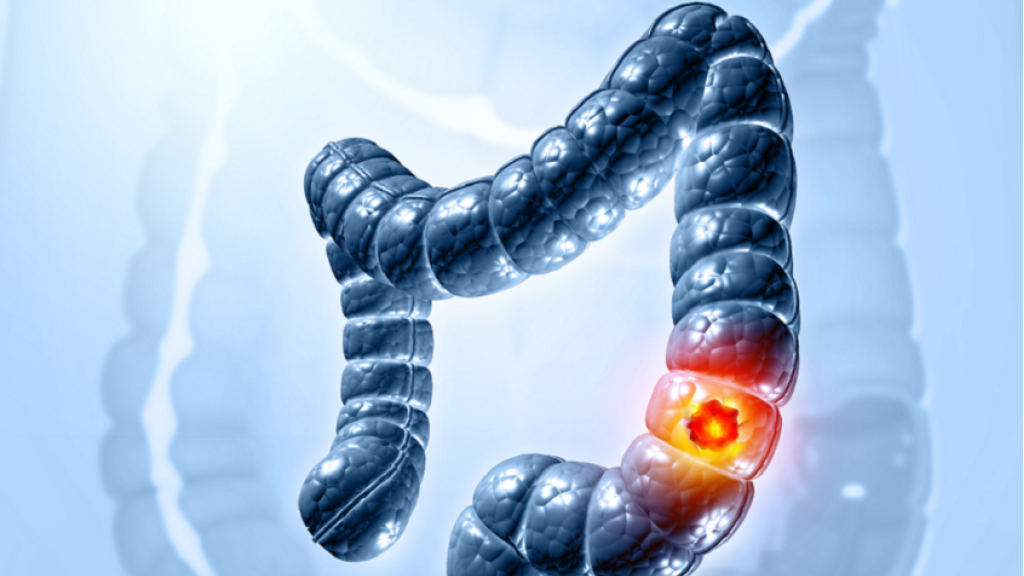 عامل خفي يزيد من خطر سرطان القولون