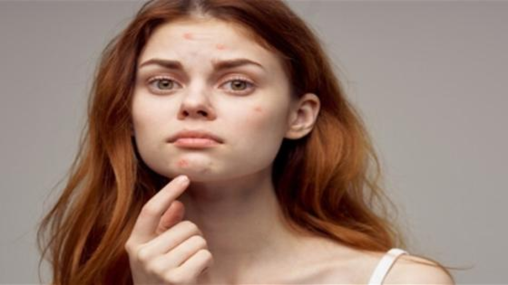 لماذا يزداد حب الشباب في الشتاء؟ حلول فعّالة للحفاظ على صحة البشرة