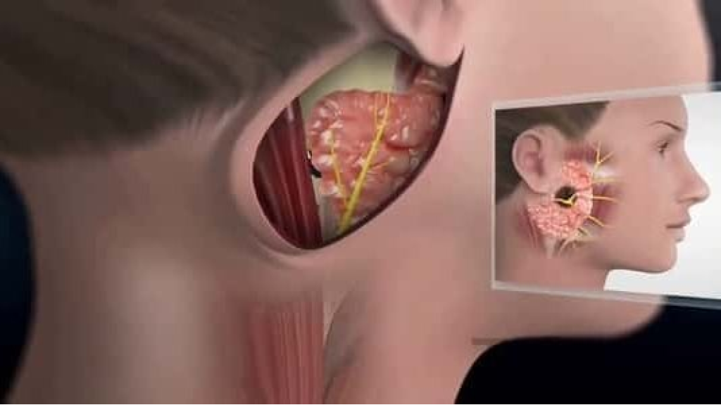 تشبه الانفلونزا .. اكتشف أعراض غدة النكاف