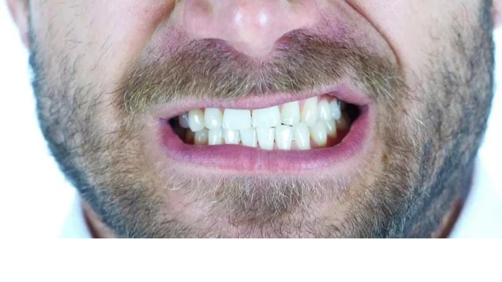 «الصرير السني».. علامات «مُقلقة» تضر صحة الأسنان