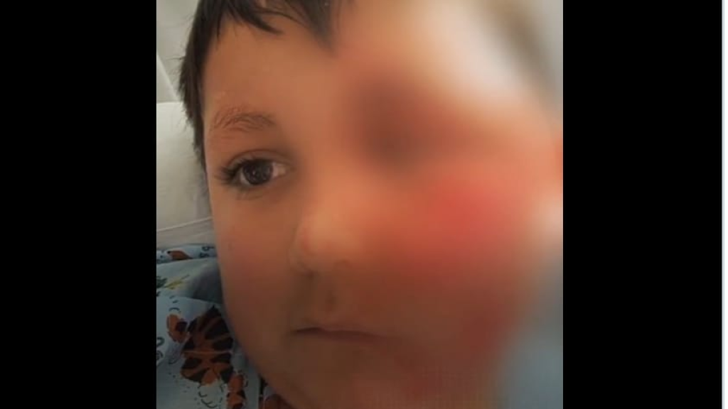 بسبب “ترند” تيك توك.. إصابة طفل بحروق خطيرة (فيديو)