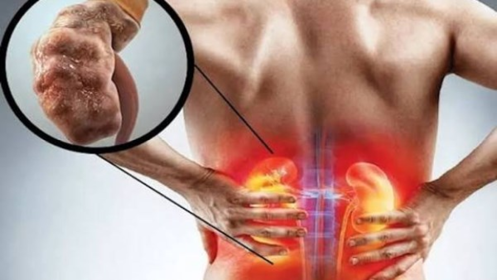 انتبه في رمضان.. خطأ شائع عند شرب الماء في الإفطار قد يضر الكلى